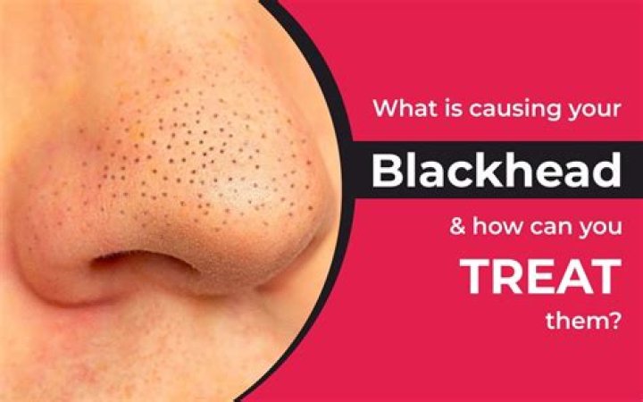 Are blackheads hairs?