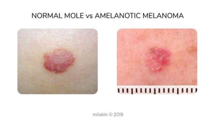 Are melanomas always dark?