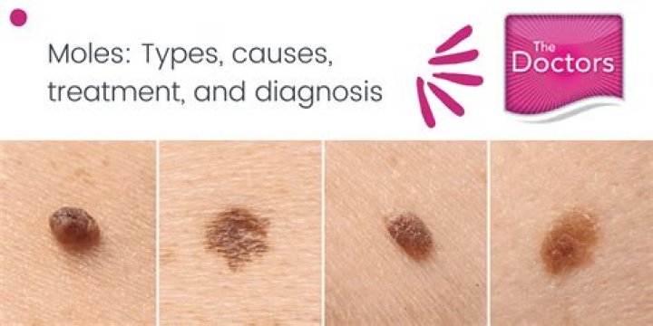 Are Raised moles normal?