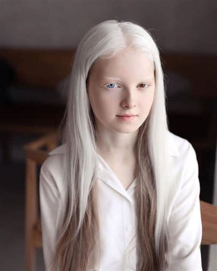 Are there any famous albinos?