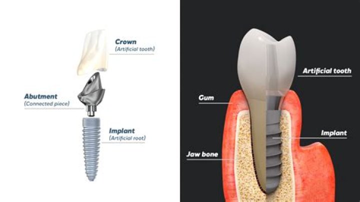 Are tooth implants worth it?