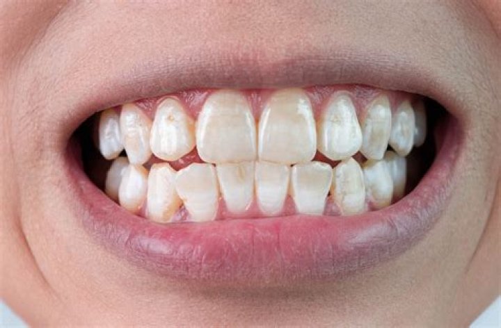 Are white spots on teeth permanent?