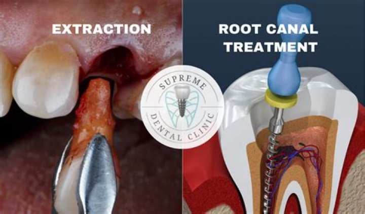 Can a failed root canal be fixed?