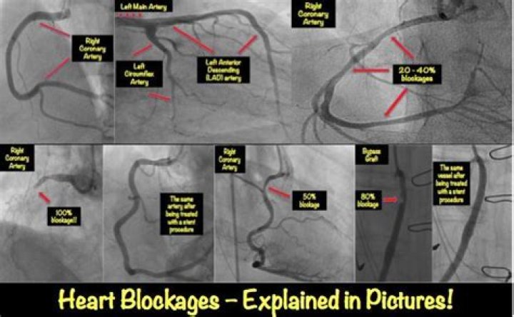 Can a heart CT scan detect blocked arteries?