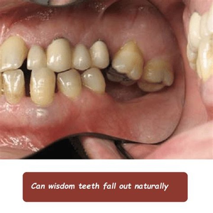 Can a loose tooth fall out while sleeping?