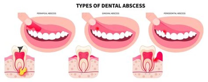 Can a popcorn hull cause an abscess?