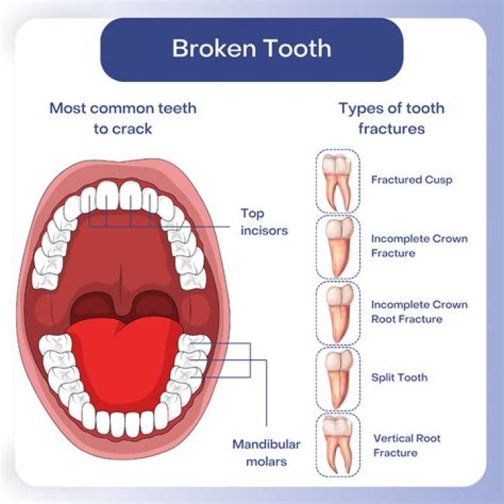 Can a punch break a tooth?
