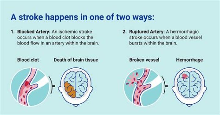 Can a stroke make you childish?