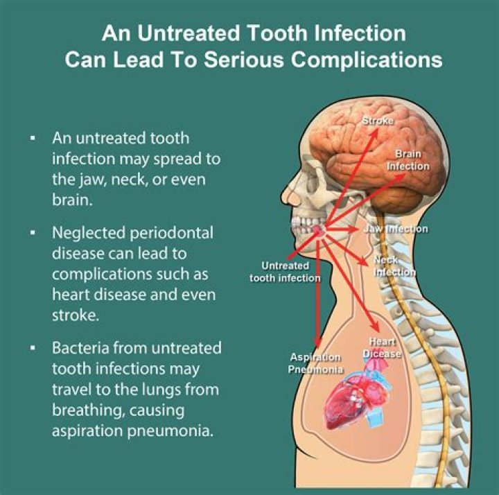 Can a tooth infection affect your brain?