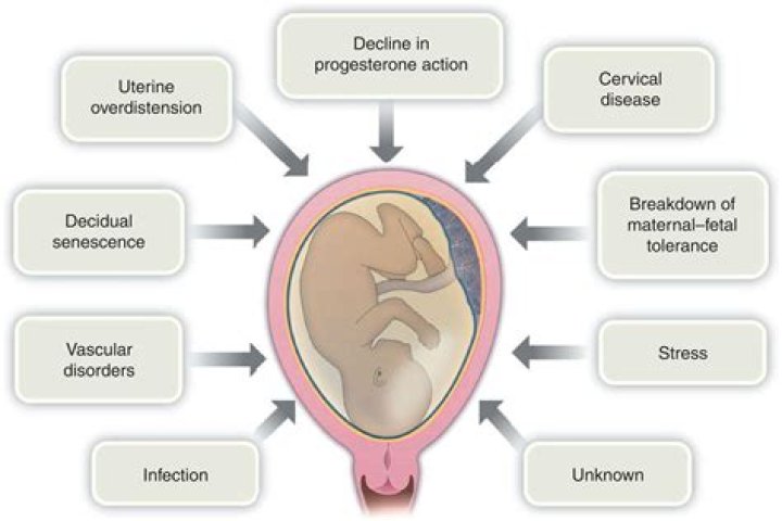 Can a urine infection cause stillbirth?