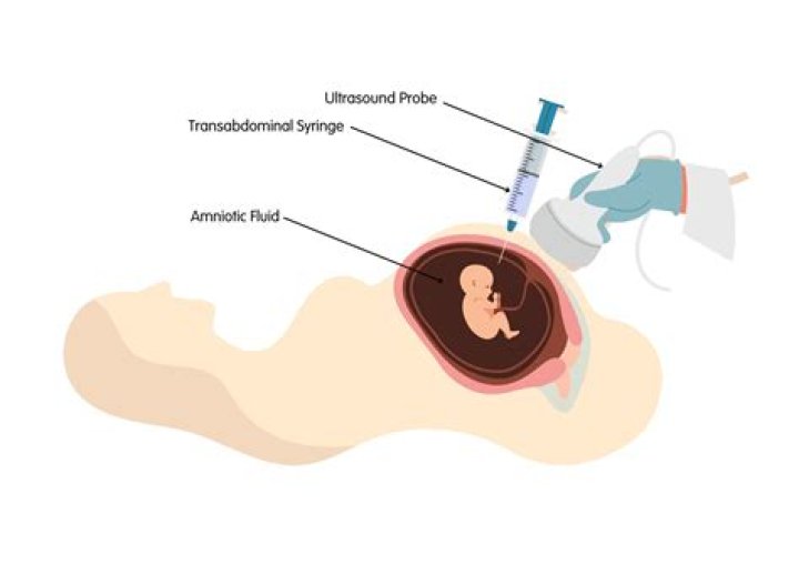 Can amniocentesis detect NF1?