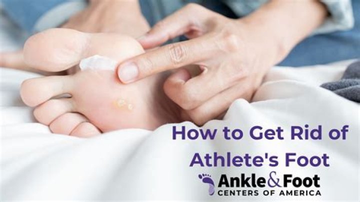 Can athlete's foot go away on its own?
