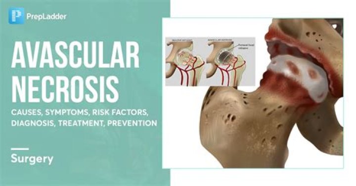 Can avascular necrosis cause knee pain?