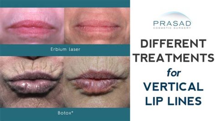 Can Botox Help vertical lip lines?