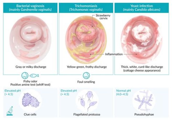Can BV turn into HPV?