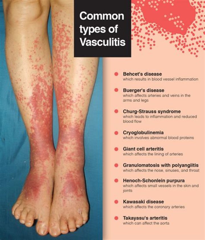 Can Covid bring on vasculitis?