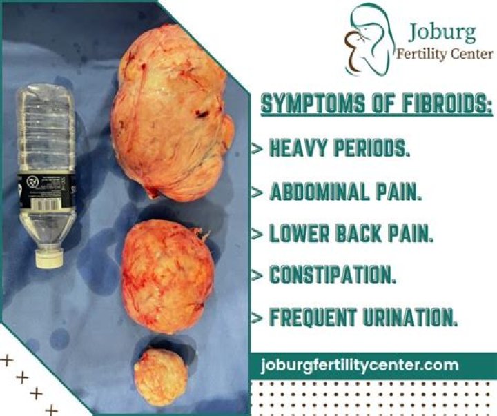 Can fibroids be caused by abortion?