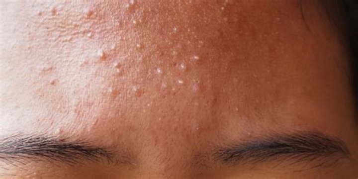 Can honey clear pimples?