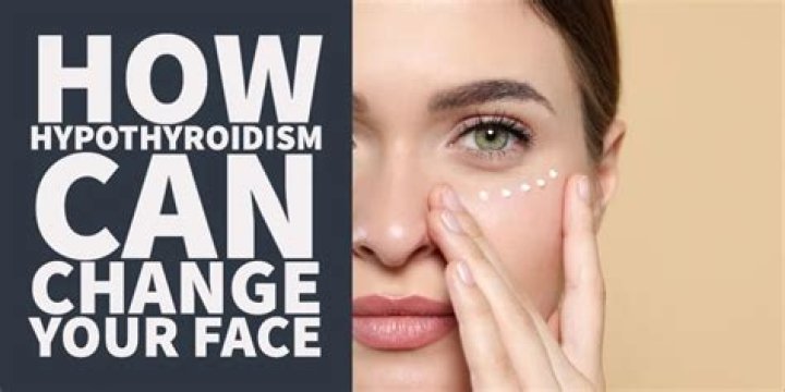 Can hypothyroidism affect your eyes?