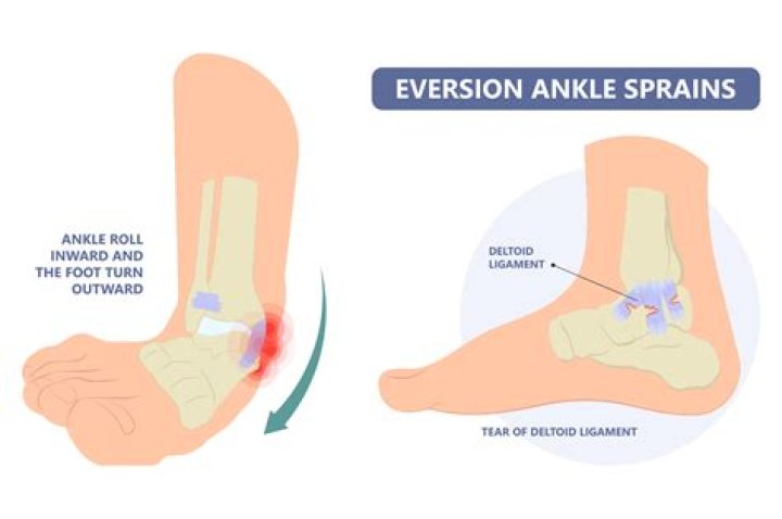 Can I call out of work for a sprained ankle?