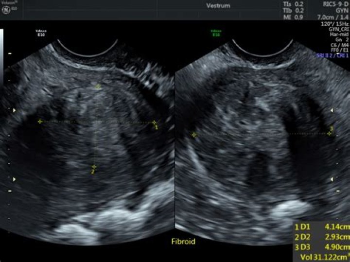 Can I get a second opinion ultrasound?