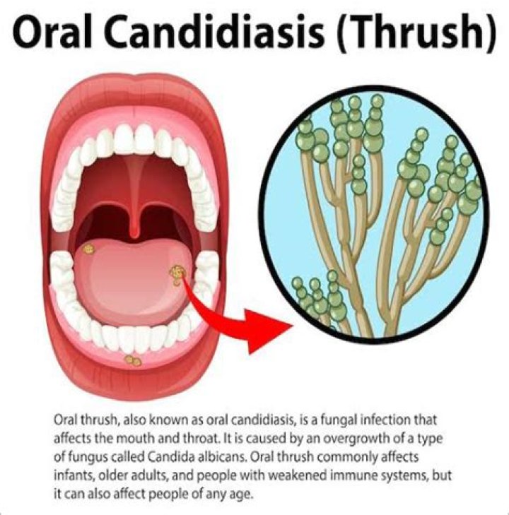Can I kiss with oral thrush?