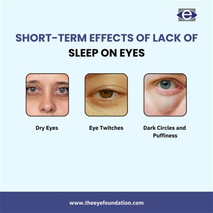 Can lack of sleep cause lazy eye?
