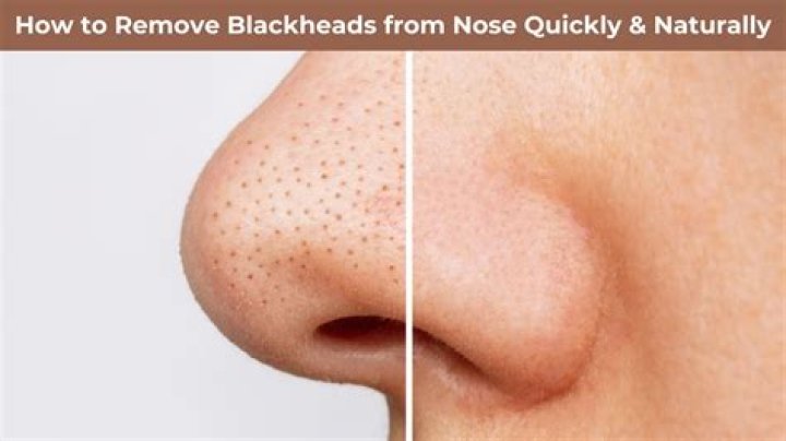 Can microneedling remove blackheads?