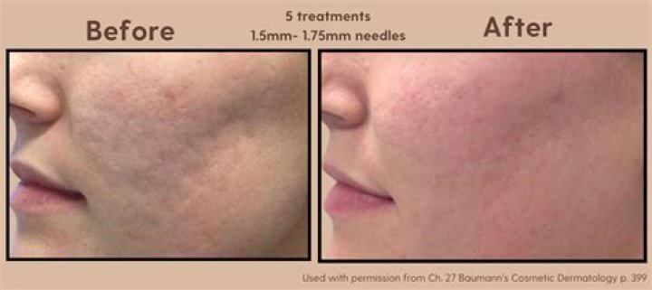 Can microneedling tighten skin?