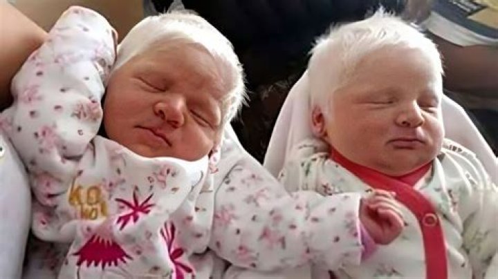 Can someone be born with white hair?