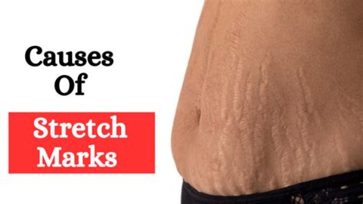 Can stretch marks appear overnight?