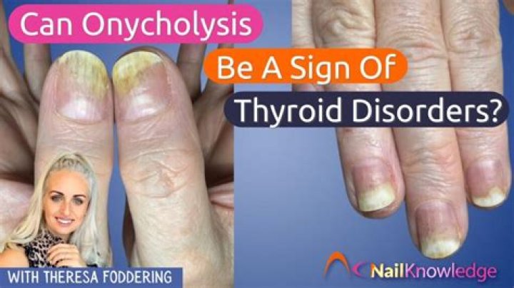 Can thyroid affect nails?