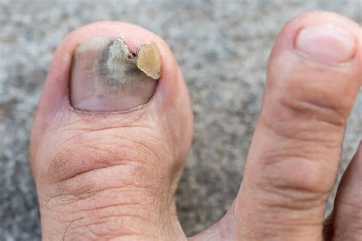 Can toe fungus make you sick?