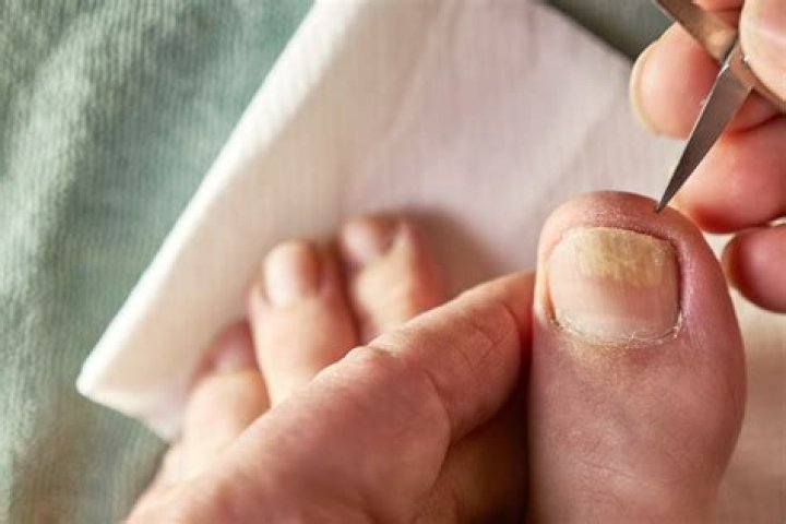Can toenail fungus be cured permanently?