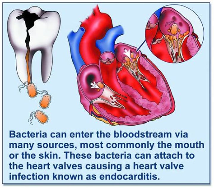 Can tooth infection lead to heart problems?