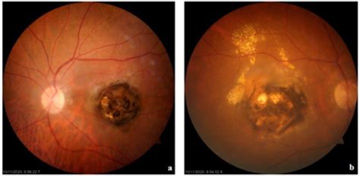 Can toxoplasmosis cause blindness?