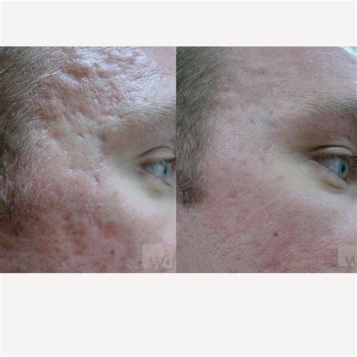 Can tretinoin be used on eyelids?