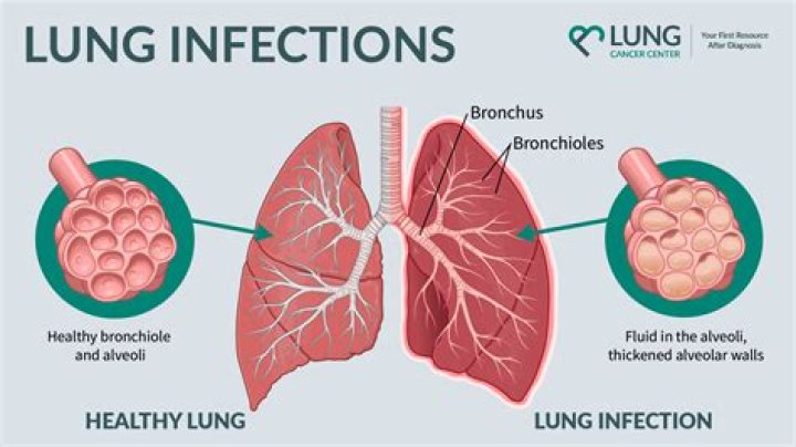 Can vaping collapse your lungs?
