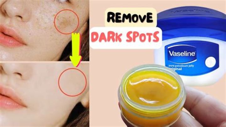 Can Vaseline remove dark spots?