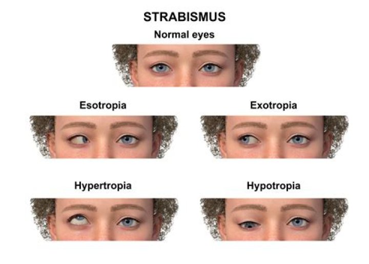 Can watching phone cause strabismus?