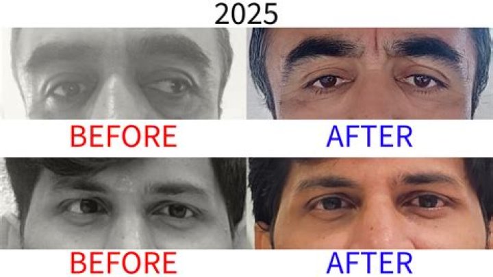 Can you drink alcohol after strabismus surgery?