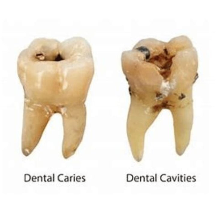Can you get cavities from not washing your retainer?