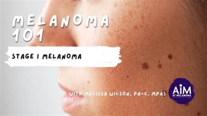 Can you have melanoma for 15 years?