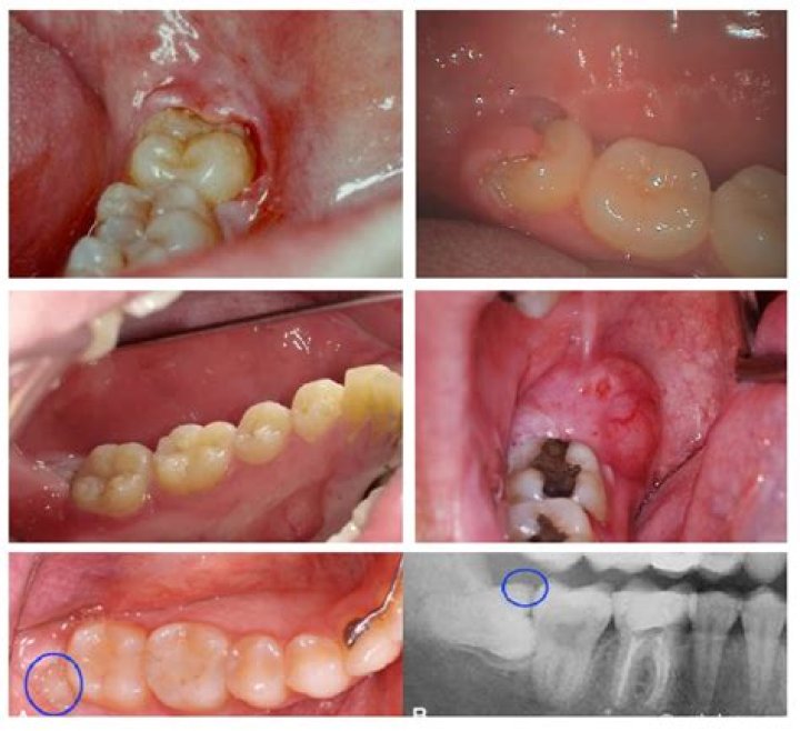 Can you inhale a tooth?