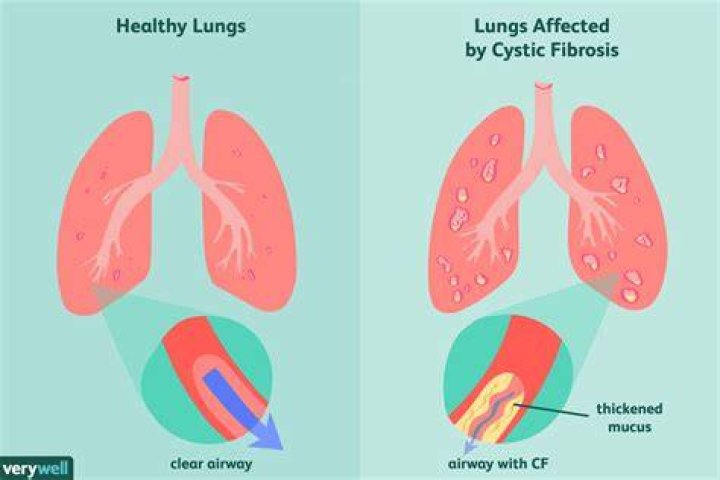 Can you outgrow cystic fibrosis?