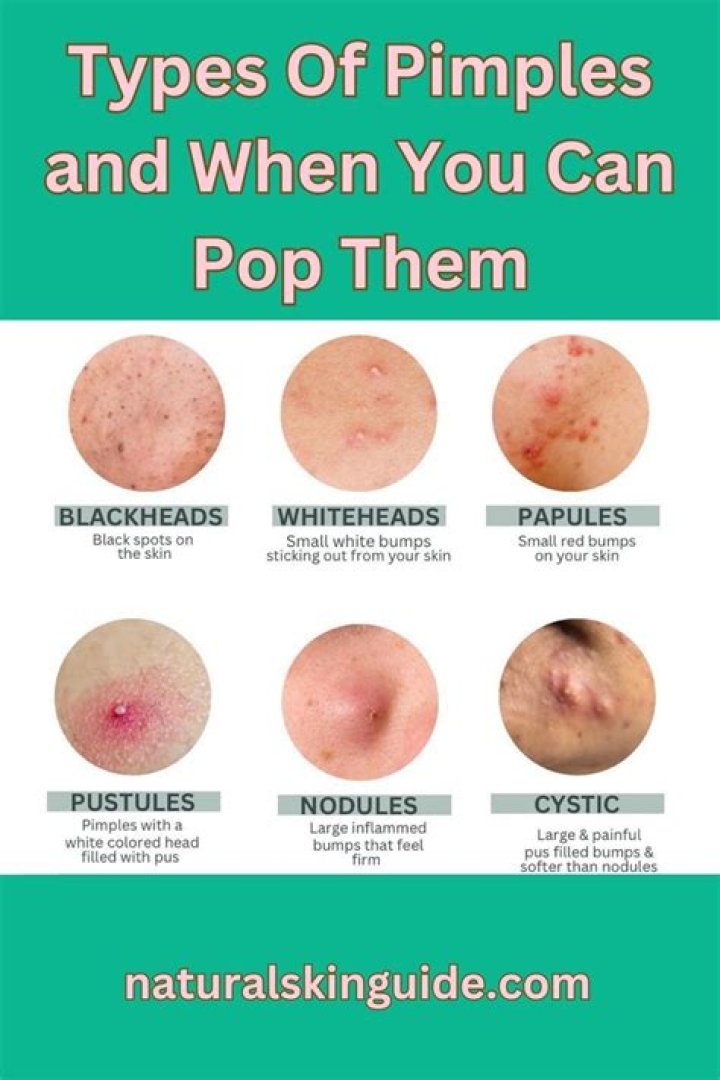 Can you pop a pimple backwards?