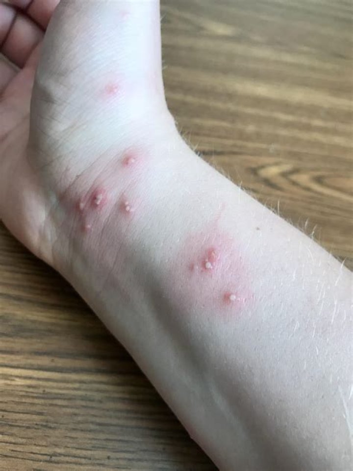 Can you put Neosporin on ant bites?
