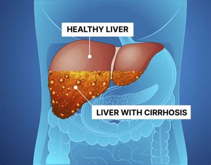 Can you reverse early cirrhosis?