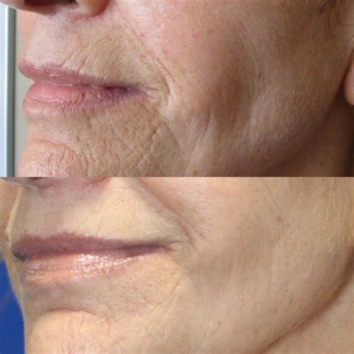 Can you rub wrinkles out of your face?