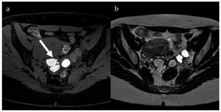 Can you see endometriosis on pelvic MRI?